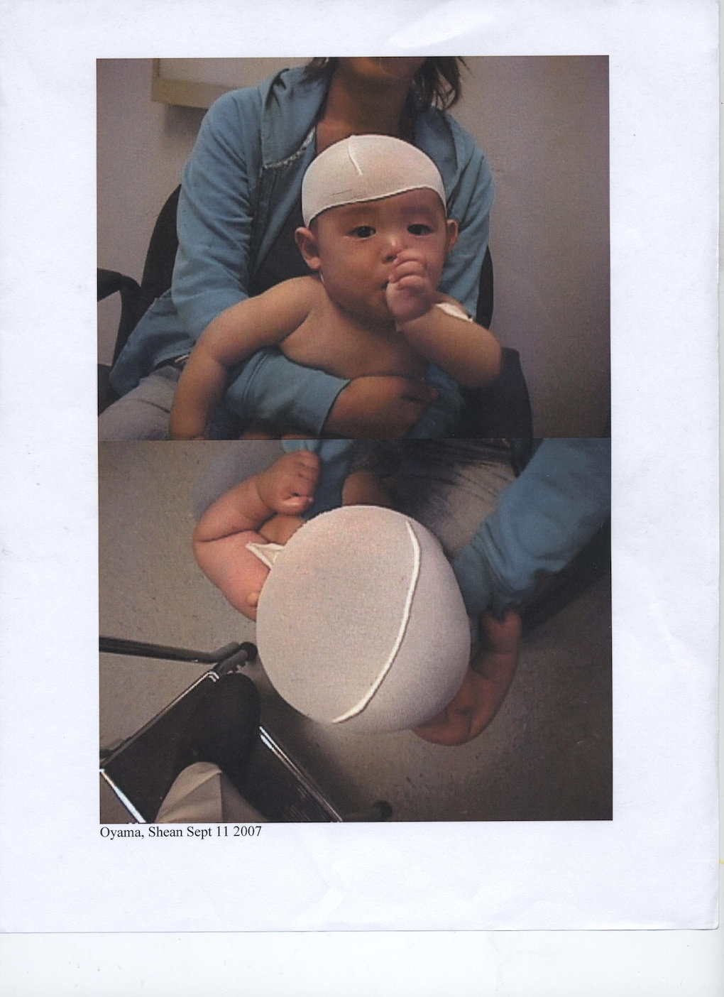 アメリカで赤ちゃんの頭の形を治す 私の体験談 ヘルメット治療の様子 通院記録 アメリカ生活 子育てガイド